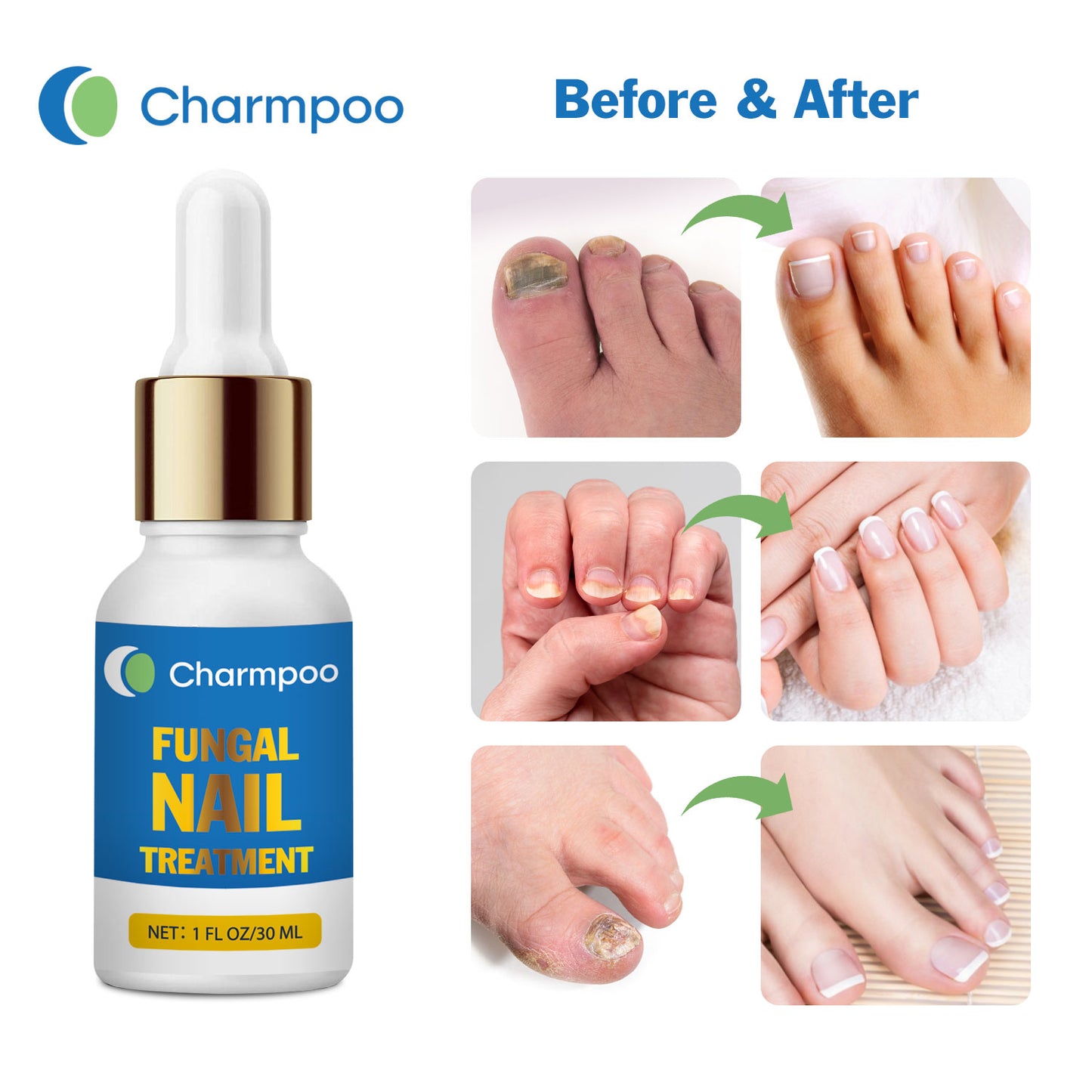 Charmpoo Fungus Nail Treatment (for Toenail)